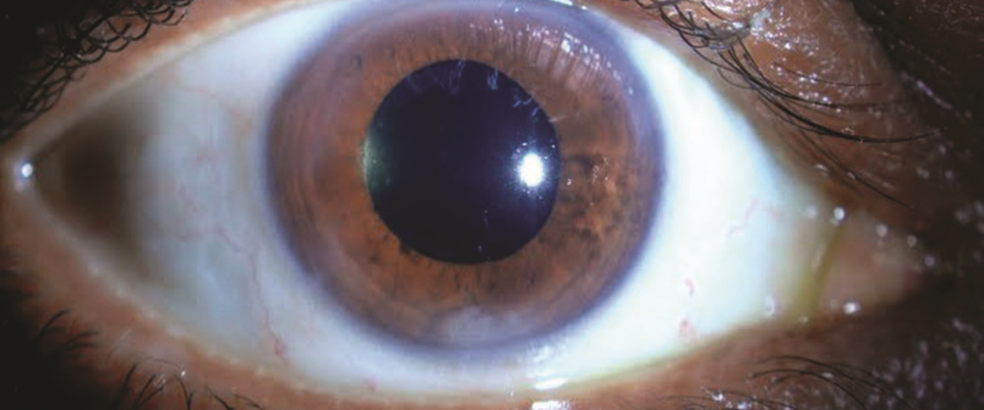 what-to-know-about-the-recovery-period-after-cataract-surgery