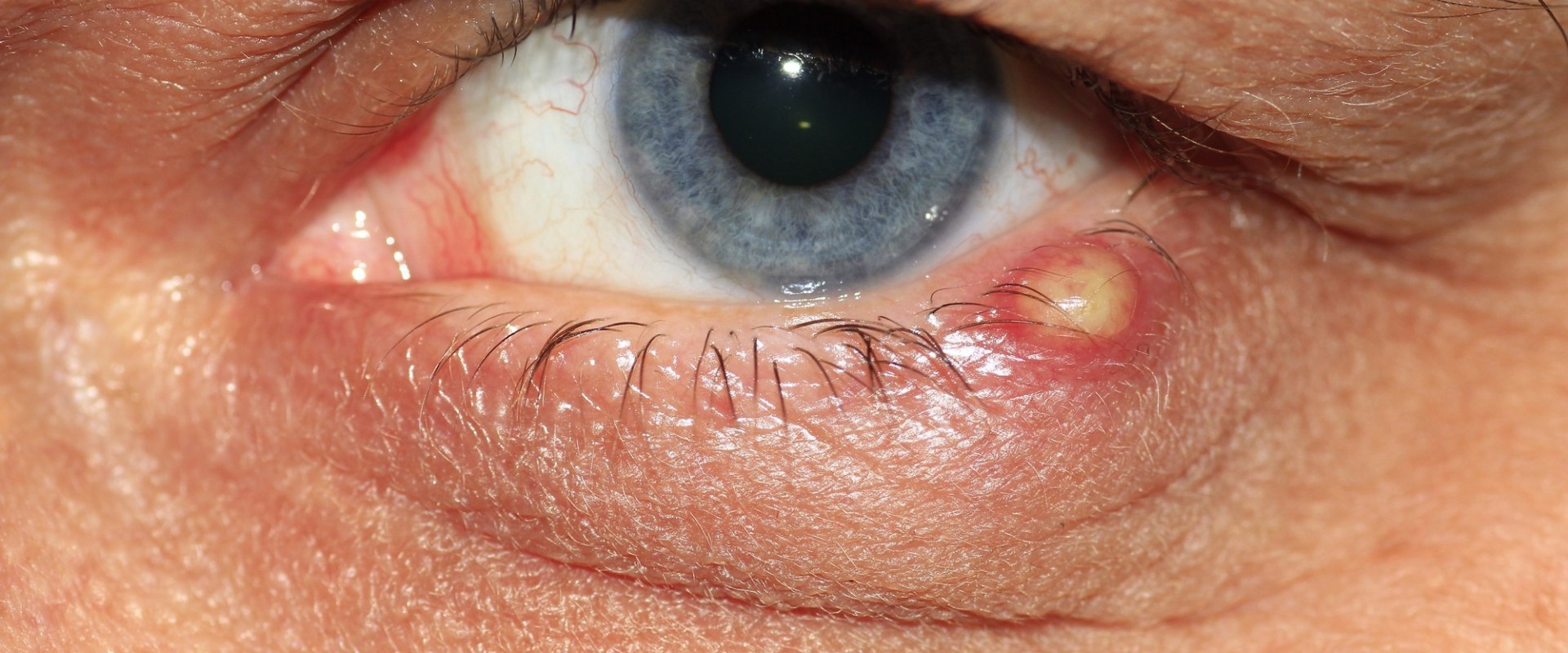 what-are-the-signs-of-an-eye-infection-after-cataract-surgery