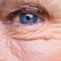 How Long Does it Take to Recover from Cataract Surgery?