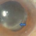 What Are the Risks of Infection After Cataract Surgery?