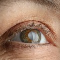 Can Cataracts Get Worse Without Surgery?