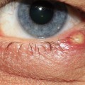 What Are the Signs of an Eye Infection After Cataract Surgery?